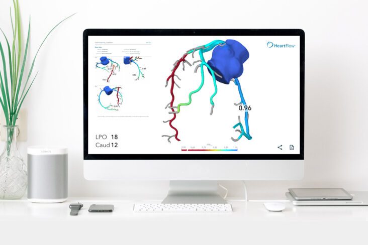 coronary-tree-ffr-ct-LAD-blocked