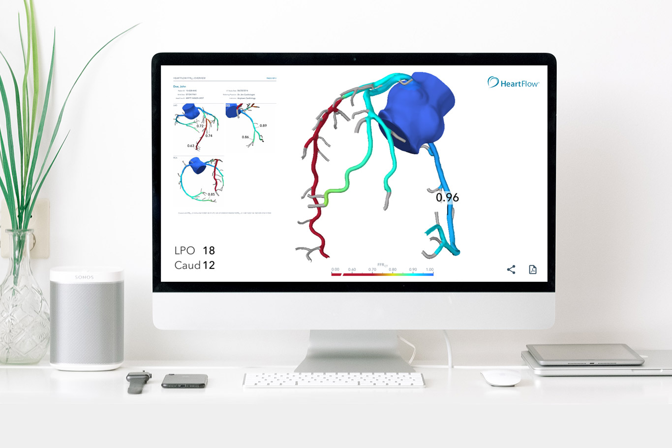 coronary-tree-ffr-ct-LAD-blocked