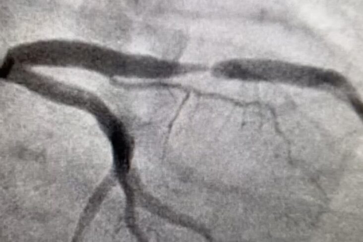 LAD-Stenosis