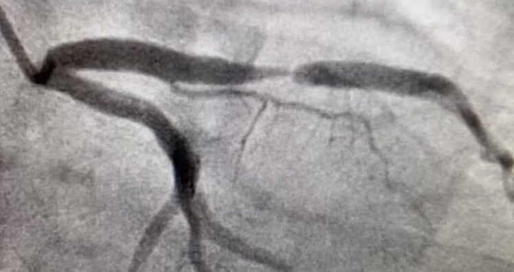 LAD-Stenosis