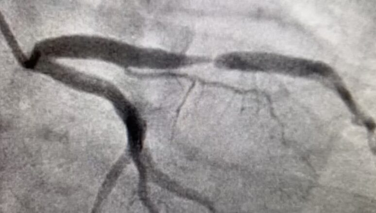 LAD-Stenosis