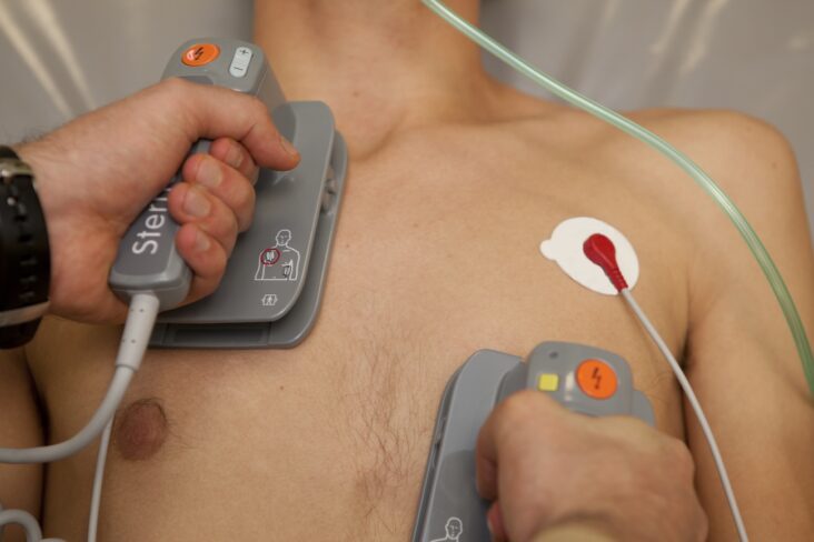 Close-up of electrical cardioversion procedure showing defibrillator paddles on a patient’s chest with ECG monitoring, used to restore normal sinus rhythm in atrial fibrillation.