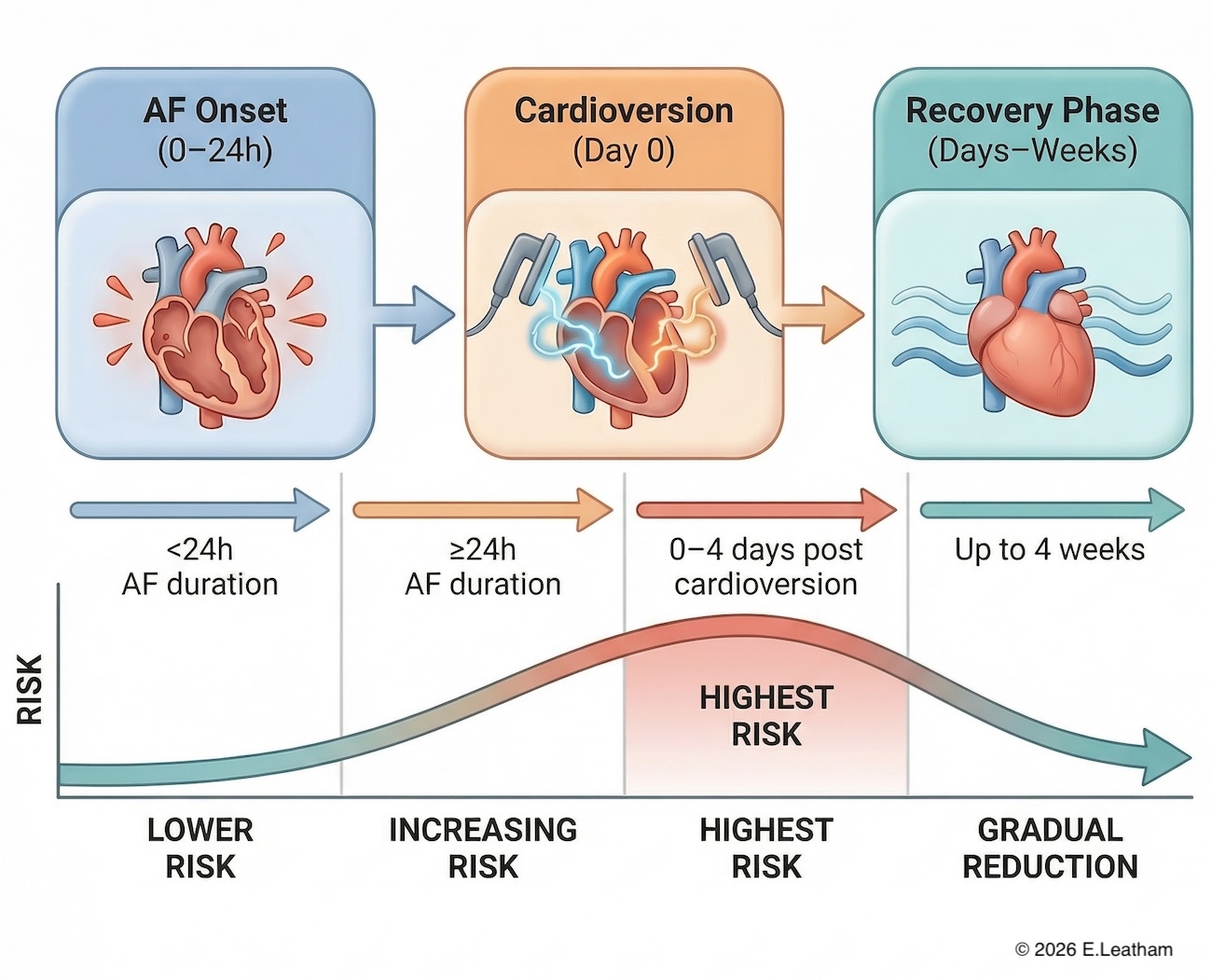 Medical infographic illustrating atrial fibrillation timeline with cardioversion, showing low risk under 24 hours, increased risk after prolonged AF, highest stroke risk in the first 0–4 days post-cardioversion due to atrial stunning, and gradual recovery over four weeks.